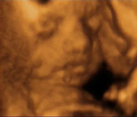 4D sonography image