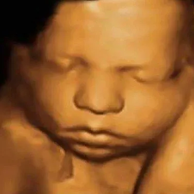 4D sonography image