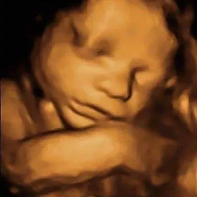 4D sonography image