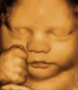 4D sonography image